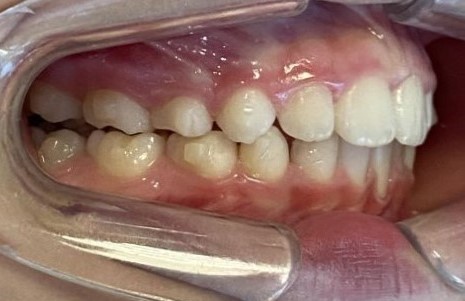 buccal_right-ADDITIONAL_ALIGNERS-stage0-lug 05 2026