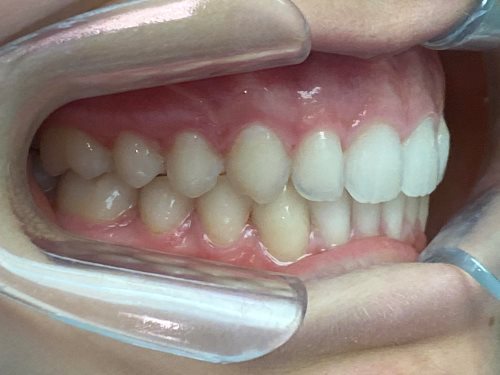 buccal_right-ADDITIONAL_ALIGNERS-stage0-lug 05 2026