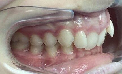 buccal_right-INITIAL-stage0-lug 05 2026 buccal_right-INITIAL-stage0-lug 05 2026