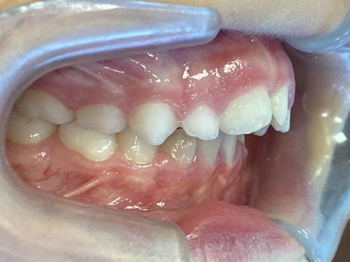 buccal_right-INITIAL-stage0-lug 05 2026 buccal_right-INITIAL-stage0-lug 05 2026
