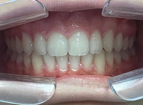 labial_anterior-ADDITIONAL_ALIGNERS-stage0-lug 05 2026