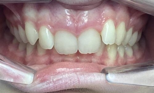 labial_anterior-INITIAL-stage0-lug 05 2026 labial_anterior-INITIAL-stage0-lug 05 2026