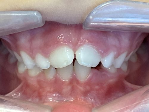 labial_anterior-INITIAL-stage0-lug 05 2026 labial_anterior-INITIAL-stage0-lug 05 2026